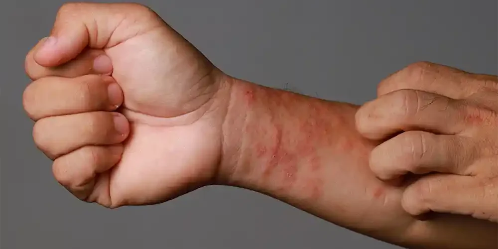 eczema