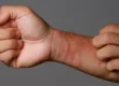 eczema
