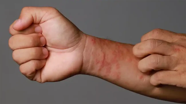 eczema